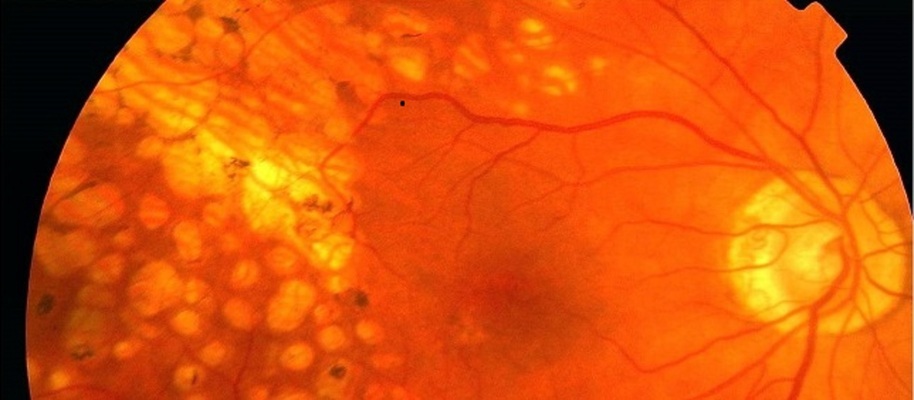 Vervolgcursus Oogheelkunde 2026 voor CHBB-geregistreerde huisartsen